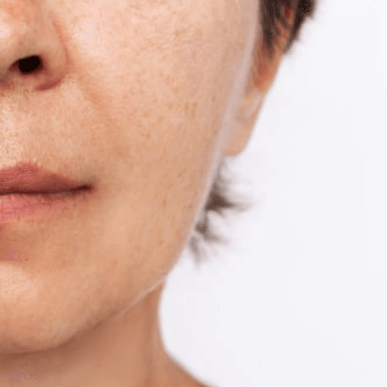 After — Laser hair removal before and after — Silkentouch client result