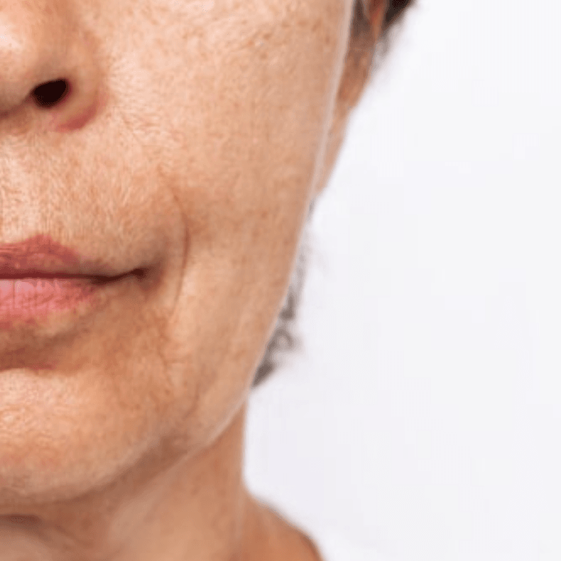 Before — Laser hair removal before and after — Silkentouch client result