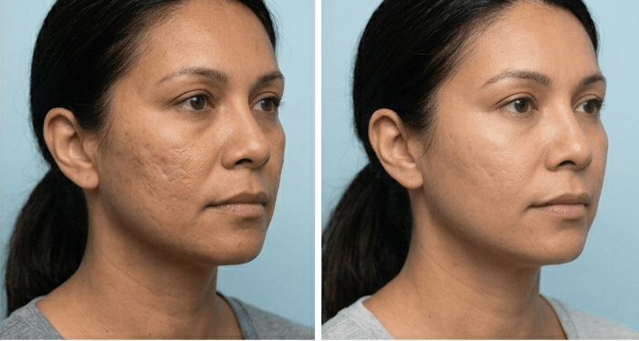 Procell Microchanneling client result at Silkentouch Aesthetics