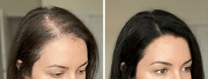 Scalp microneedling before and after — visible hair density increase after 6 sessions at Silkentouch Cambridge