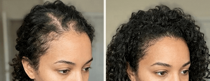 Scalp microneedling for hair restoration result at Silkentouch Aesthetics
