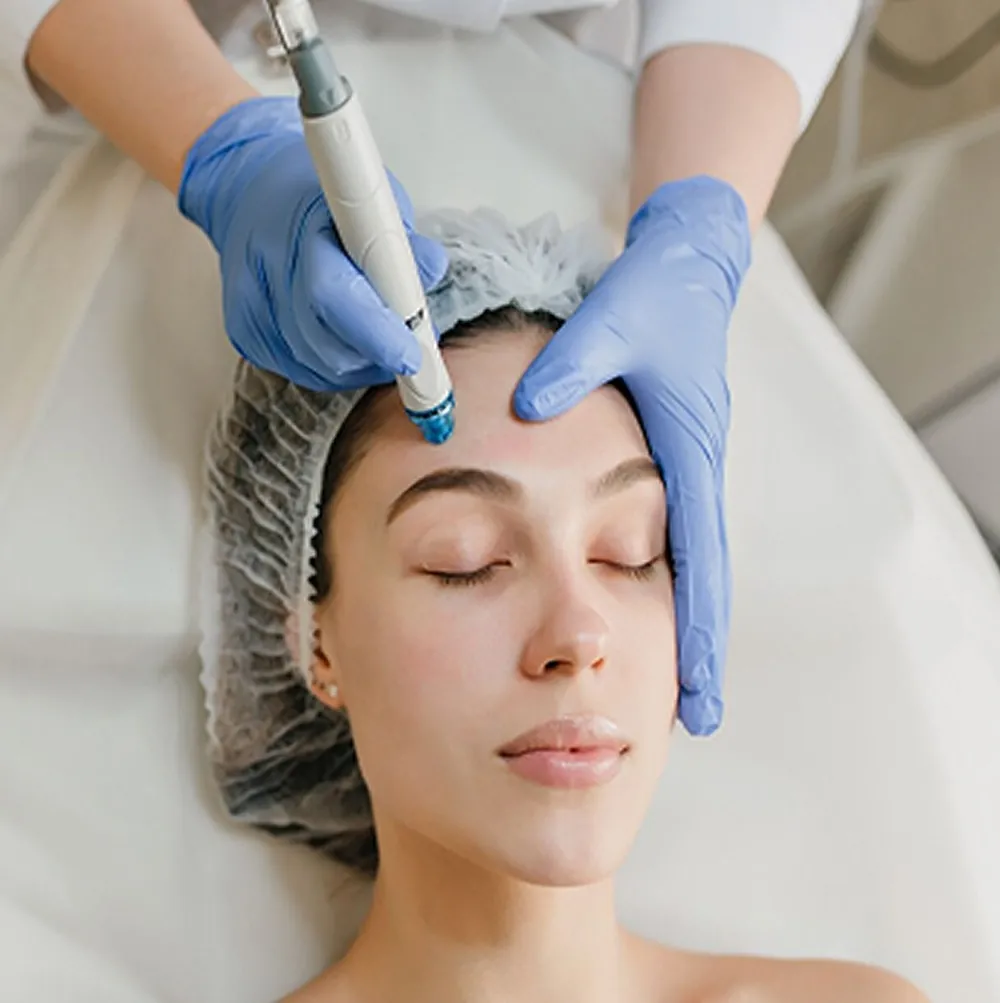 Scalp microneedling for hair restoration at Silkentouch Aesthetics