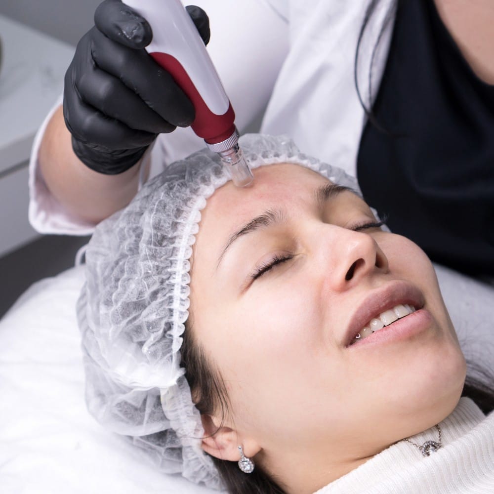 Procell Microchanneling advanced skin treatment in Cambridge ON