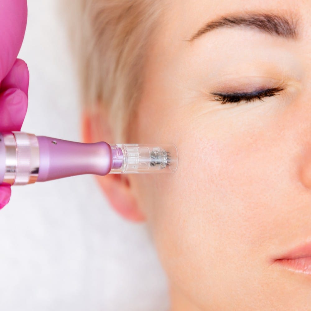 TWIST microneedling treatment for skin renewal at Silkentouch Aesthetics